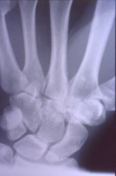 X-ray image, man, hand with bones and joints