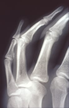 X-ray image, man, hand with bones and joints