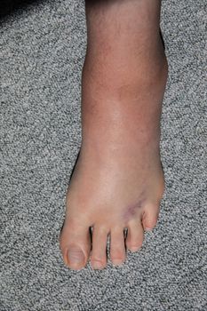 severe swelling and hematoma of the left foot after bending and ligament stretching