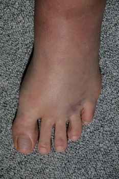 severe swelling and hematoma of the left foot after bending and ligament stretching