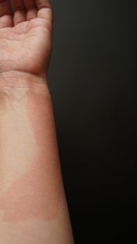 Female hand covered with red spots, close-up. Allergic reaction to an antibiotic. Hand on the black background - vertical photo