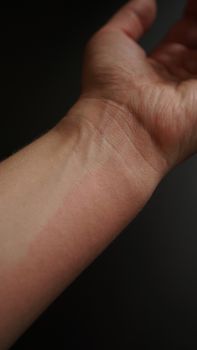 Female hand covered with red spots, close-up. Allergic reaction to an antibiotic. Hand on the black background - vertical photo