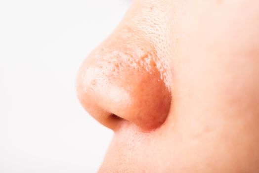 Closeup Asian young woman large pores have freckles cheek oily, acne pimple on nose, studio shot isolated on white background, Healthcare beauty skin face problem concept