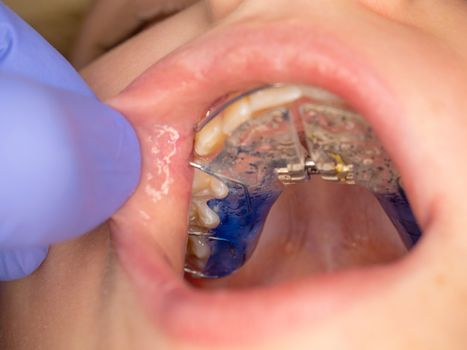 Hhands in rubber medical gloves holding colorful braces. Dentist showing metal braces