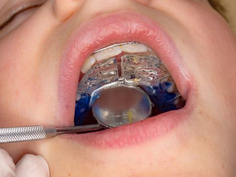 Doctor check setting of palatal braces for correction of birth defect. Child with orthodontic appliance.