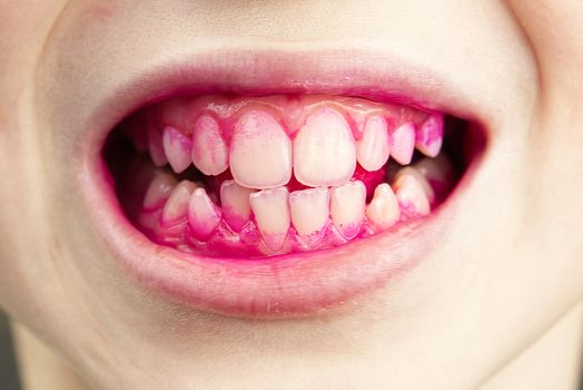 Plaque disclosing tablets in work. after using - effect. close up photo of young boy tooth. Dental plaque pill concept