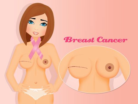 illustration of Breast Cancer awareness month
