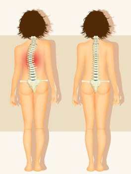 illustration of woman with scoliosis problem