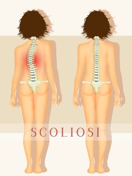 illustration of scoliosis disease