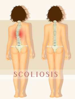 illustration of scoliosis problem