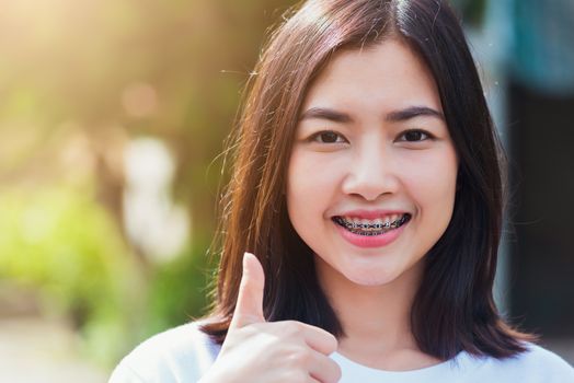 Portrait of Asian teen beautiful young woman smile have dental braces on teeth laughing outdoor, Medicine and dentistry concept