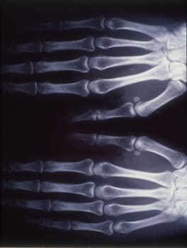 X-ray image, man, hand with bones and joints