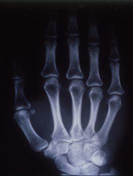 X-ray image, man, hand with bones and joints