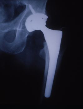 Artificial hip joint in the human thigh X-ray image