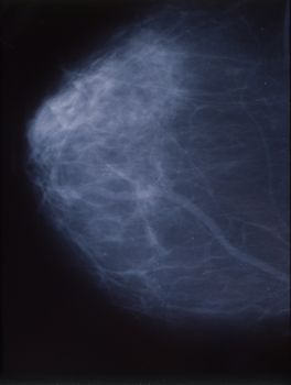 X-ray as mammography of the female breast