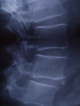 X-ray image of the spine for medical diagnosis