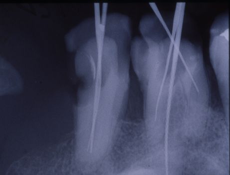 X-ray image of teeth with fillings and bridges