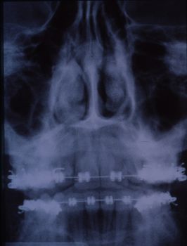 X-ray image of the dentition with braces and teeth
