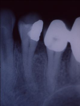 X-ray image of teeth with fillings and bridges