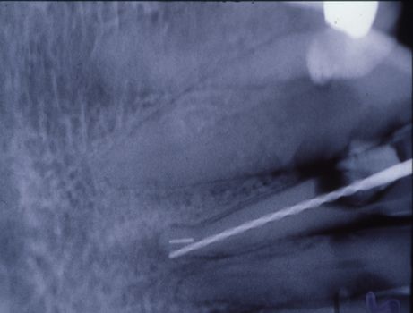 X-ray image of teeth with fillings and bridges