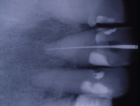 X-ray image of teeth with fillings and bridges