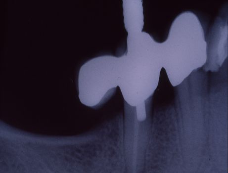 X-ray image of teeth with fillings and bridges