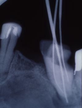 X-ray image of teeth with fillings and bridges