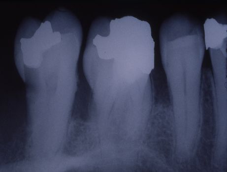 X-ray image of teeth with fillings and bridges