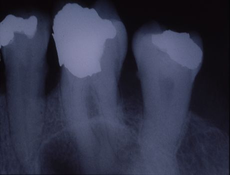 X-ray image of teeth with fillings and bridges