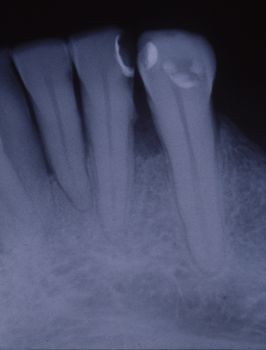 X-ray image of teeth with fillings and bridges