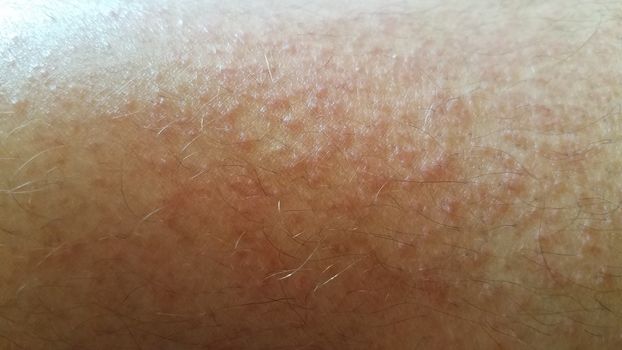 red itchy rash or inflammation and bumps on male leg