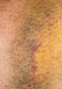 Large bruise hematoma on the humans leg on the skin in different colors