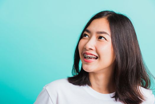 Closeup teen Asian beautiful young woman smile have dental braces on teeth laughing she looking side away space, studio shot isolated on a blue background, medicine and dentistry female mouth concept