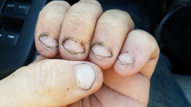 bitten and gross dirty fingernails on hand in car