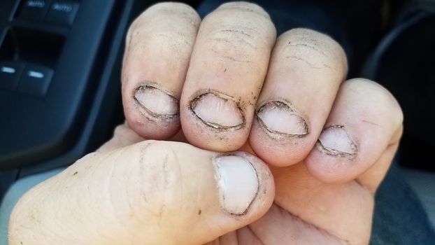 bitten and gross dirty fingernails on hand in car