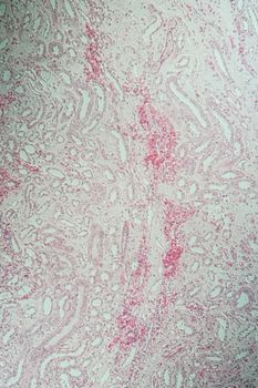 Poly nephritis, tissue under the microscope 100x
