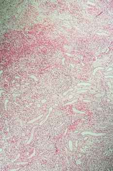 Poly nephritis, tissue under the microscope 100x