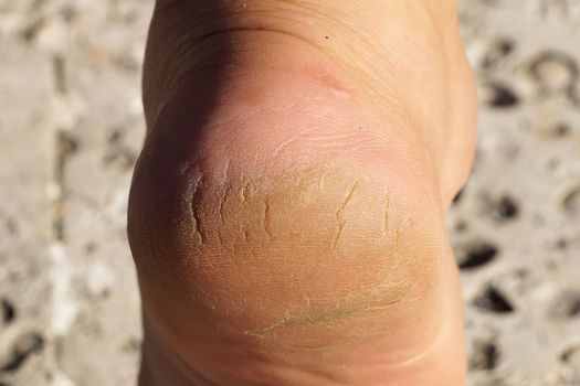 female heel with deep cracks close-up