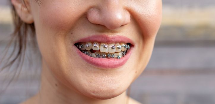 brasket system in smiling mouth, macro photo teeth, close-up lips, macro shot