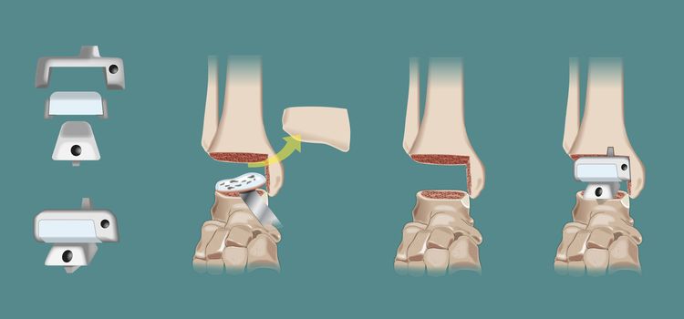 Surgical intervention of orthopedics prosthesis of the ankle - Arthroplasty. Vector elements are on a separate layer and can be easily removed or modified.