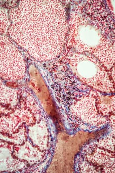 Tuberculosis tissue under the microscope 100x