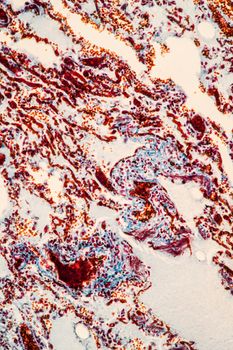 Flu of the lungs Diseased tissue 200x