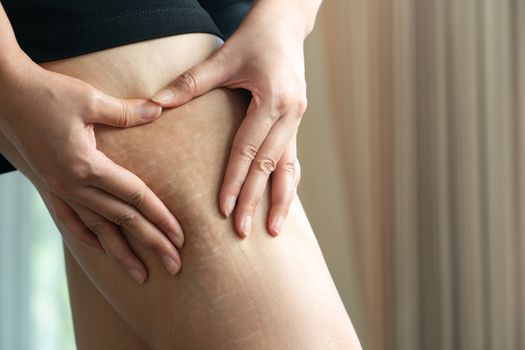 Female hand holds fat cellulite and stretch mark on leg at home, women diet style concept