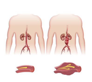 Schematic sketch of abdominal aortic aneurysm.