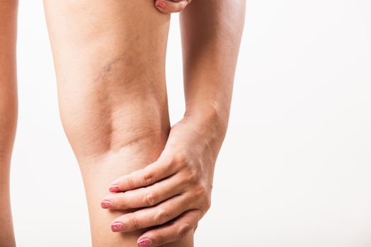 Closeup young Asian woman painful varicose and spider veins on leg, studio shot isolated on white background, Healthcare medical and hygiene skin body varicose veins problems care concept