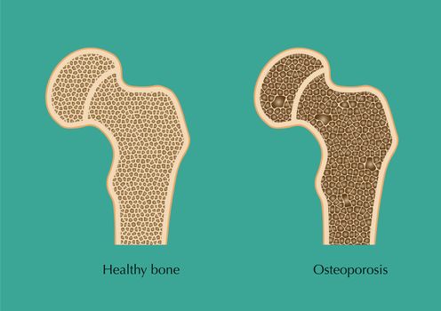 Schematic sketch of normal femur and osteoporosis. 