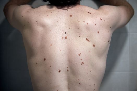 Middle-aged hispanic man examines the size, color and shape of a mole he has in his cheek. Prevention of melanoma, skin cancer.