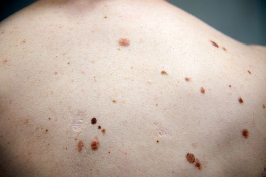 Middle-aged hispanic man examines the size, color and shape of a mole he has in his cheek. Prevention of melanoma, skin cancer.