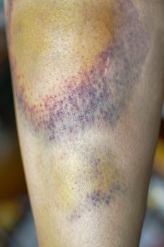 Ankle bruises, injuries caused by running. Nasty looking bruise on leg. Shot of a bruise on the womans thigh or hematoma. Sport injury. Damage bumpy tissue.