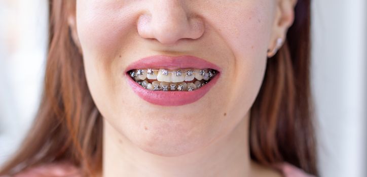 Brasket system in a girl's smiling mouth, macro photography of teeth, close-up of lips